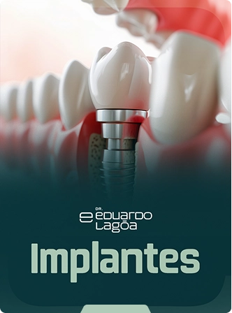 IMPLANTES